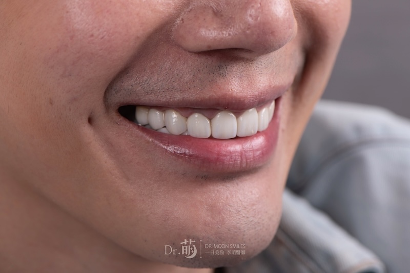 完成台北全瓷冠、陶瓷貼片療程，王凱呈現更完美的笑容