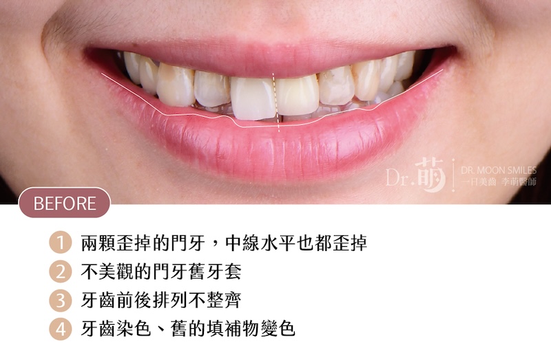 患者療程前上排牙齒近照,有牙齒不整齊、門牙歪斜、牙齒染色等問題