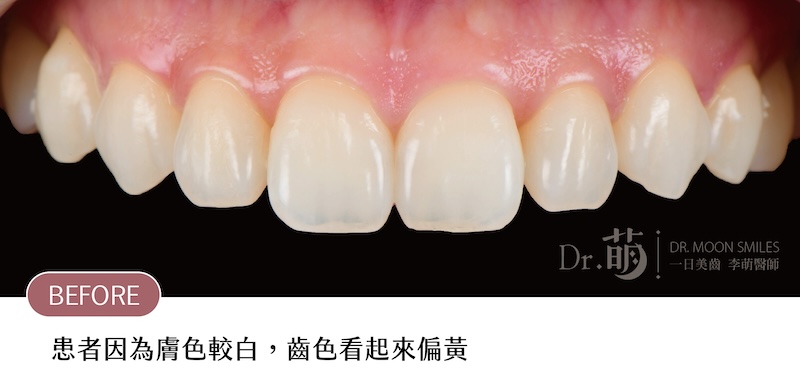 療程前患者上排牙齒近照,由於膚色較白,讓牙齒齒色看起來偏黃