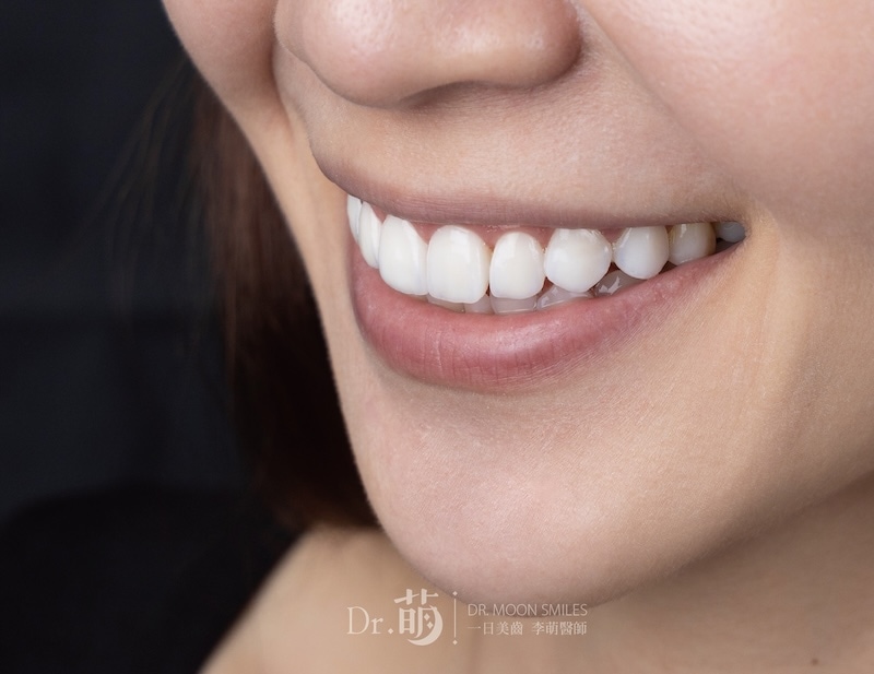 完成陶瓷貼片牙齒美白,患者的牙齒顏色變得更加白皙又自然
