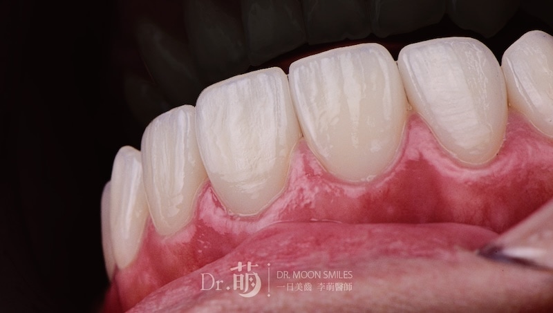 近拍陶瓷貼片細節，可見自然琺瑯質紋理與表面光澤，展現高擬真牙齒美感