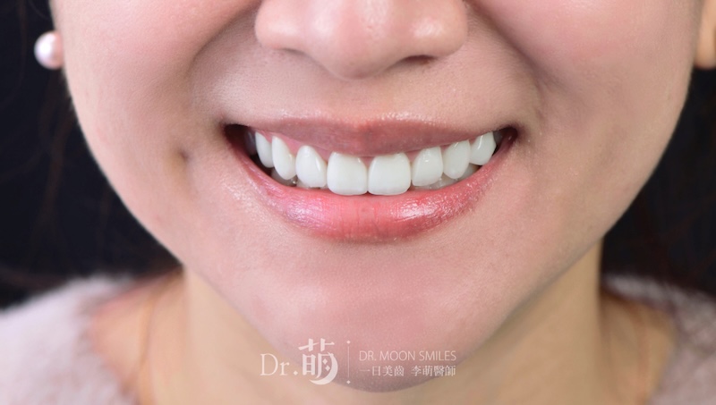 完成陶瓷貼片,患者牙齒變得白皙且圓潤飽滿,微笑曲線更美