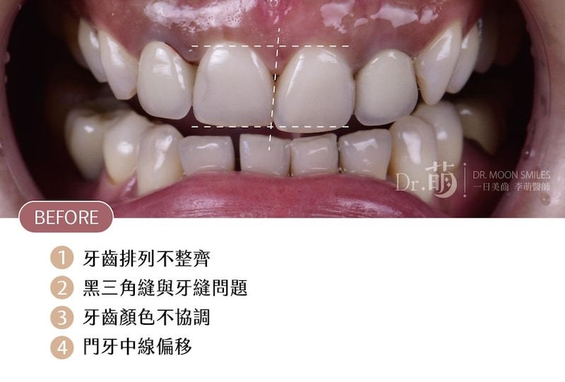 陶瓷貼片術前狀況：牙齒排列不整齊、牙縫黑三角與牙齒中線偏移